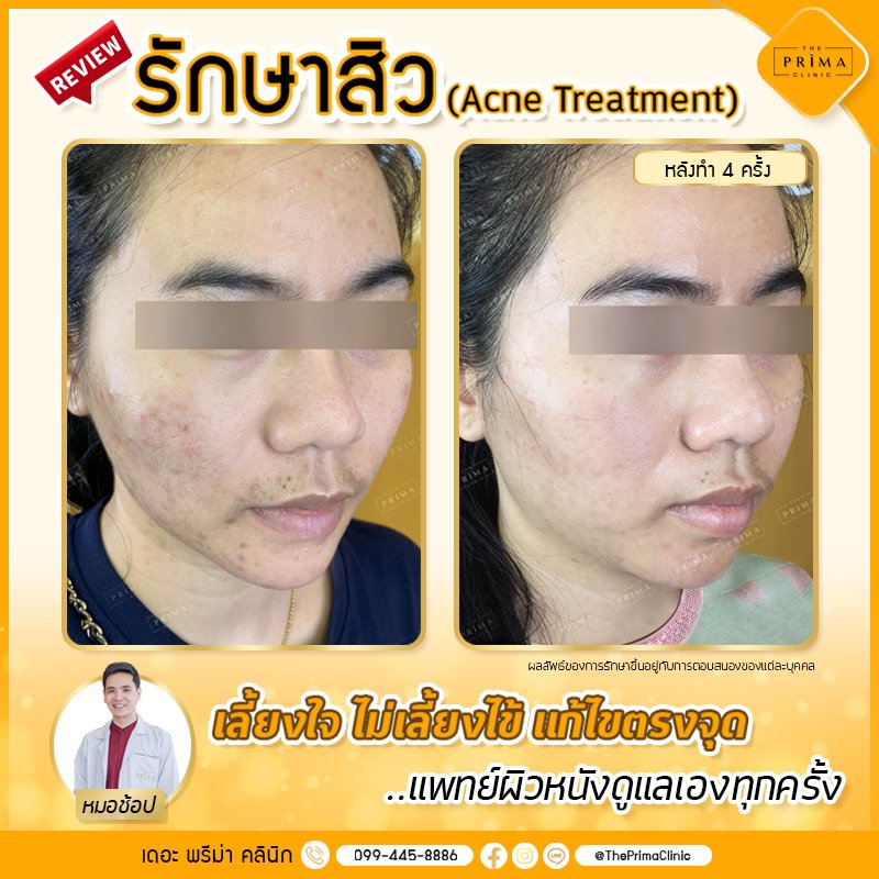 The Prima Clinic คลินิกรักษาสิว ฝ้า กระ พัทยา ดูแลครอบคลุมทุกปัญหาของผิวที่กังวล - 2