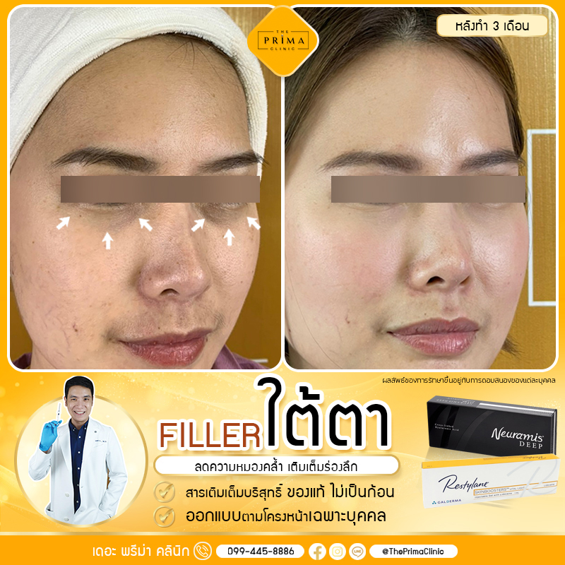 The Prima Clinic บริการฉีดฟิลเลอร์ พัทยา ด้วยเทคนิคขั้นสูง ปรับรูปหน้าเห็นผลได้เร็ว - 2