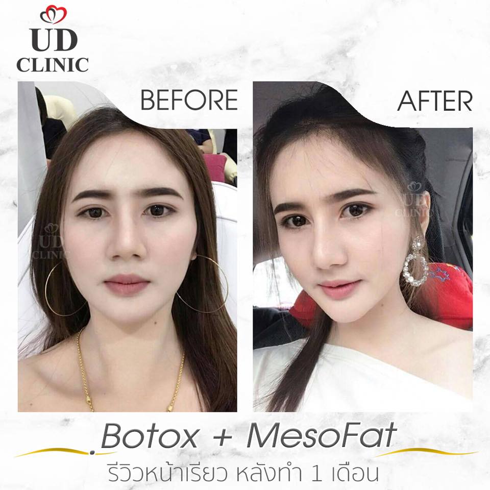 UD Clinic Korat บริการโบท็อก นครราชสีมา เคลียร์ทุกปัญหาของรูปหน้าและผิวพรรณ - 2