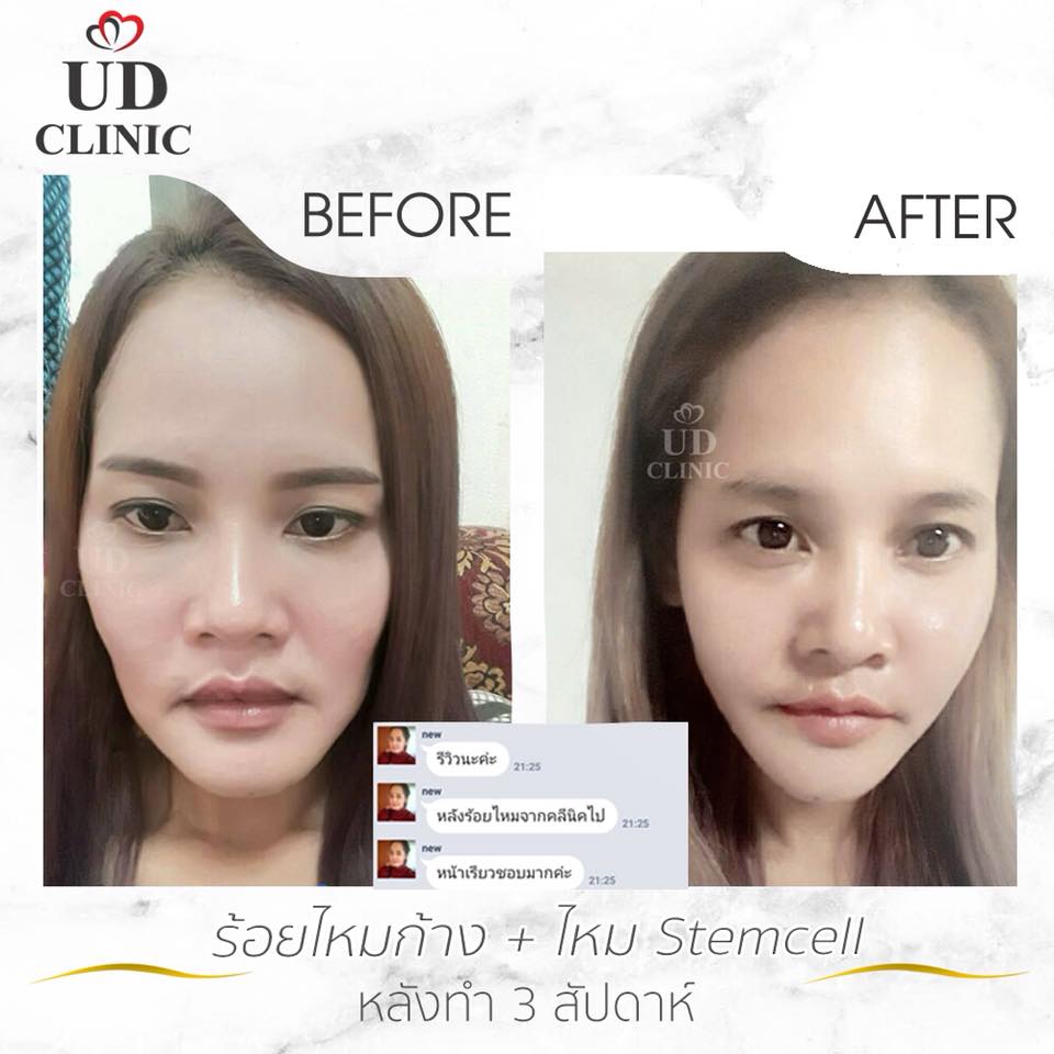 UD Clinic Korat ร้อยไหม นครราชสีมา สร้างสมดุลให้ใบหน้า ยกกระชับแก้หน้าบาน หน้ากลม - 2