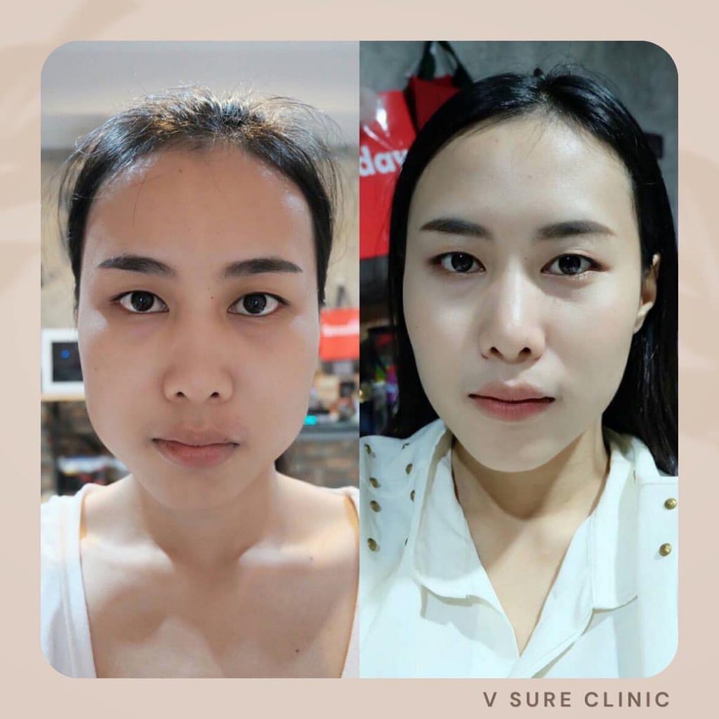 V Sure Clinic คลินิกโบท็อก นครราชสีมา เทคนิคโบลดกราม ปรับใบหน้าเรียวสวยได้อย่างมั่นใจ - 2