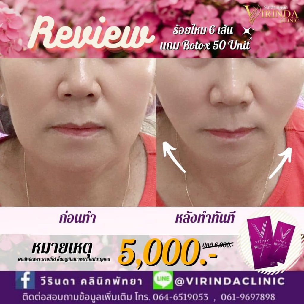 Virinda Clinic คลินิกร้อยไหม พัทยา เสริมความกระชับ ยกผิวหน้าเต่งตึงดูเรียวสวยน่าสัมผัส - 2