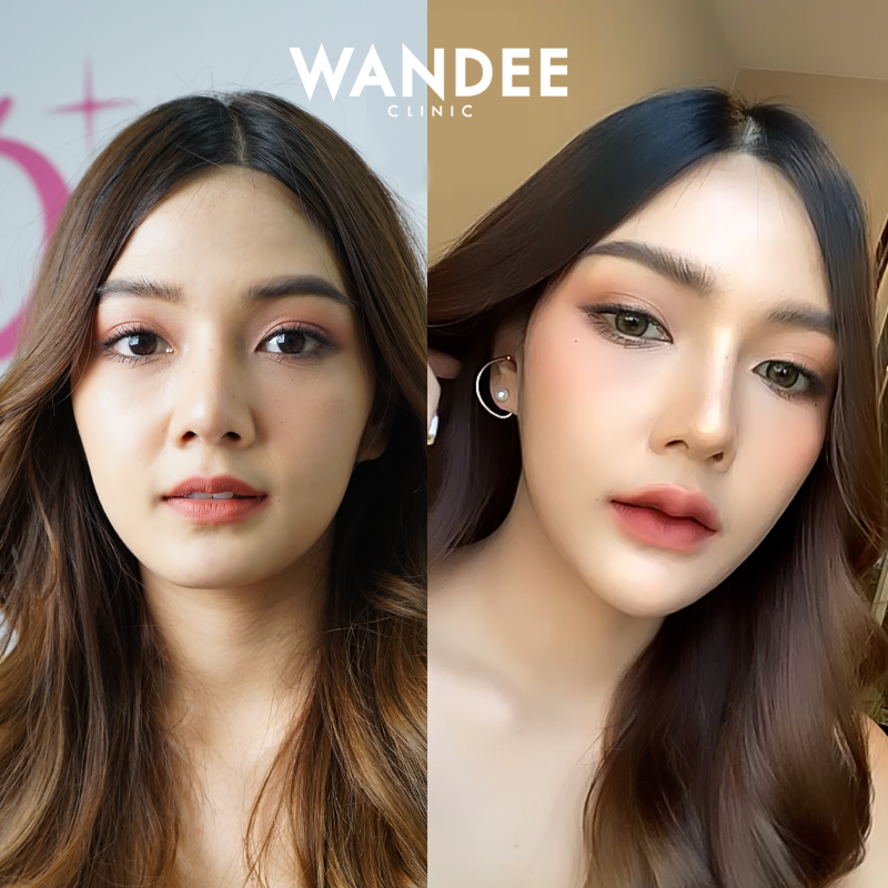 Wandee Clinic คลินิกฉีดฟิลเลอร์ พัทยา เติมเต็มทุกจุดของใบหน้าโดดเด่นหลังการฉีด - 2