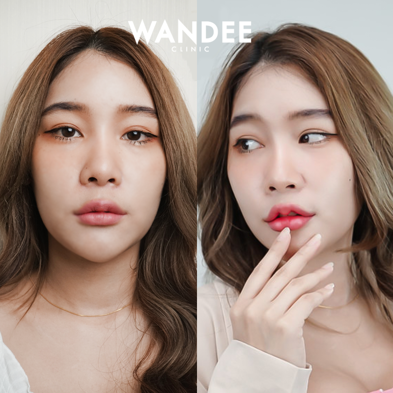 Wandee Clinic บริการฉีดฟิลเลอร์ ขอนแก่น เสริมหน้าฉ่ำ หน้าเรียว กระชับ ดูอวบอิ่มทุกจุด - 2