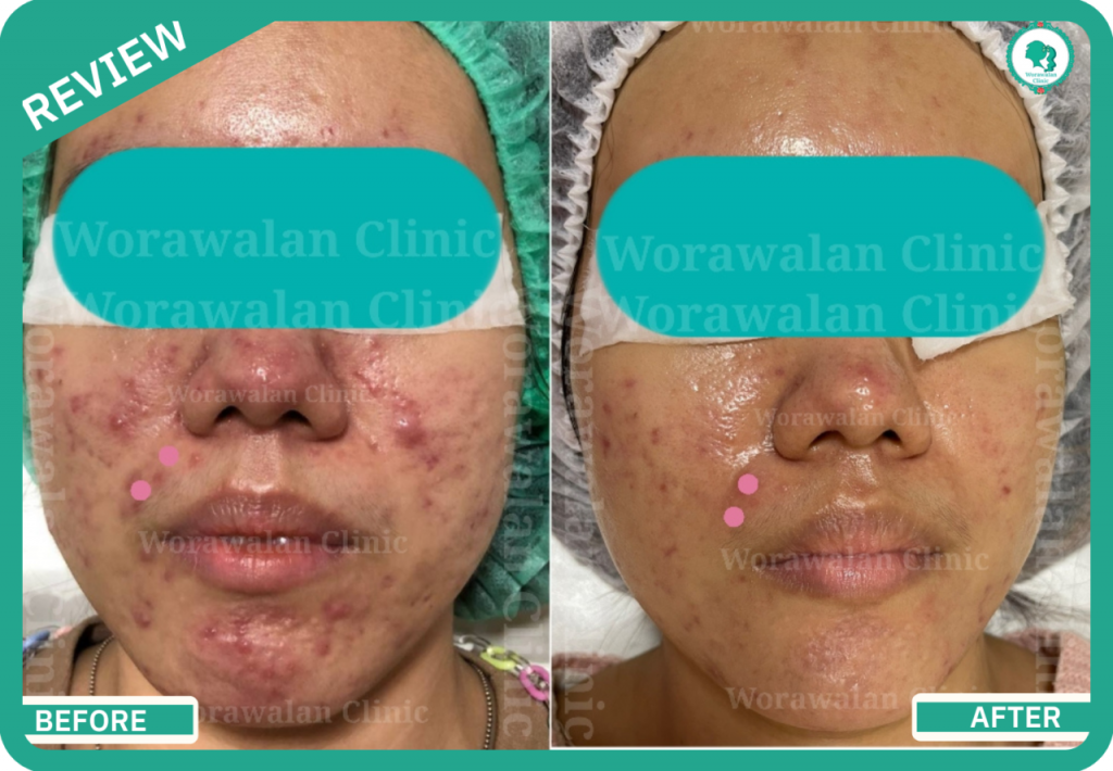 Worawalan Clinic คลินิกรักษาสิว ฝ้า กระ นครราชสีมา ดูแลรักษาครอบคลุมทุกปัญหาของผิว - 2