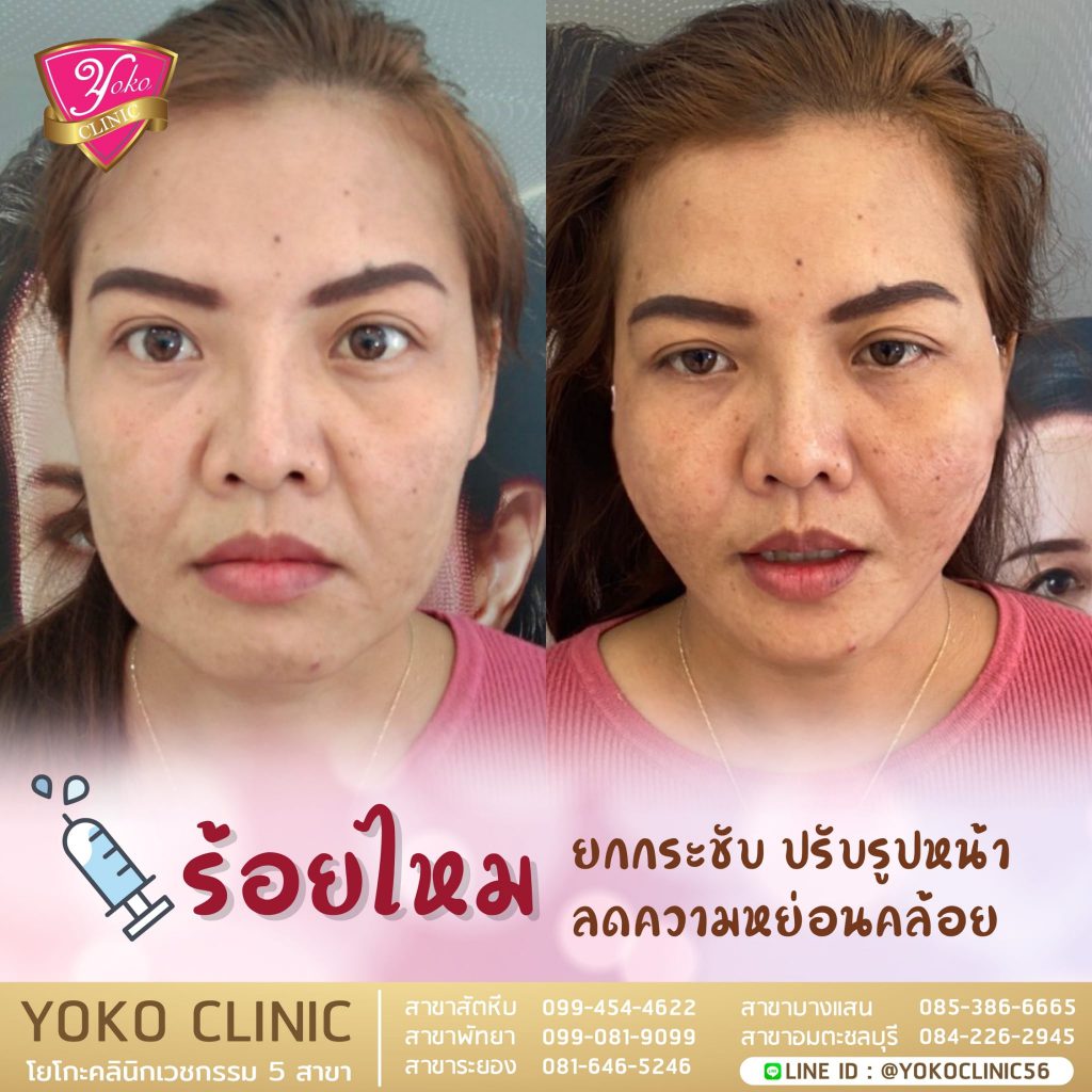 Yoko Clinic ร้อยไหม พัทยา ปรับรูปหน้าเรียว ยกกระชับแก้ม แก้เหนียงหย่อนคล้อยที่เห็นชัด - 2