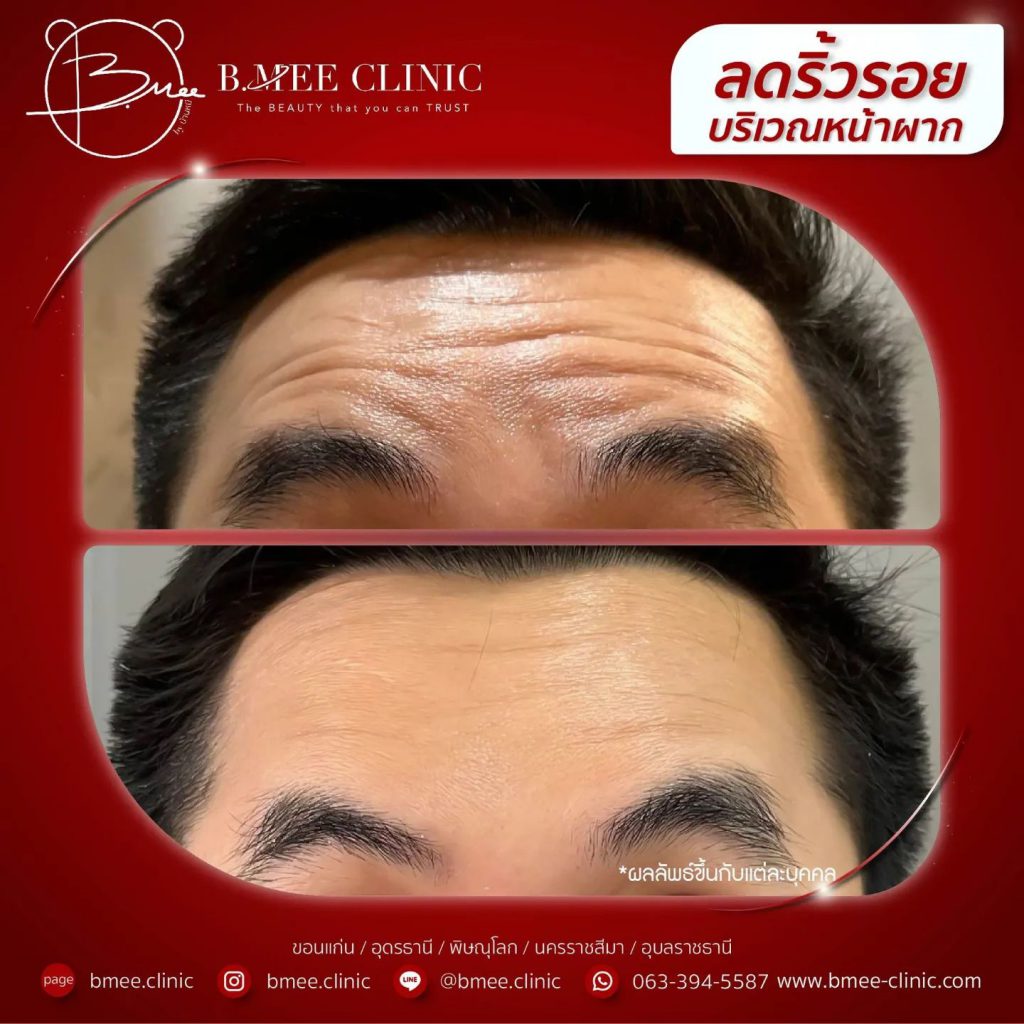 B-Mee Clinic ฉีดโบท็อก ขอนแก่น ลดริ้วรอยของผิวที่เด่นชัด ปลอดภัย ไร้สารปนเปื้อน - 2