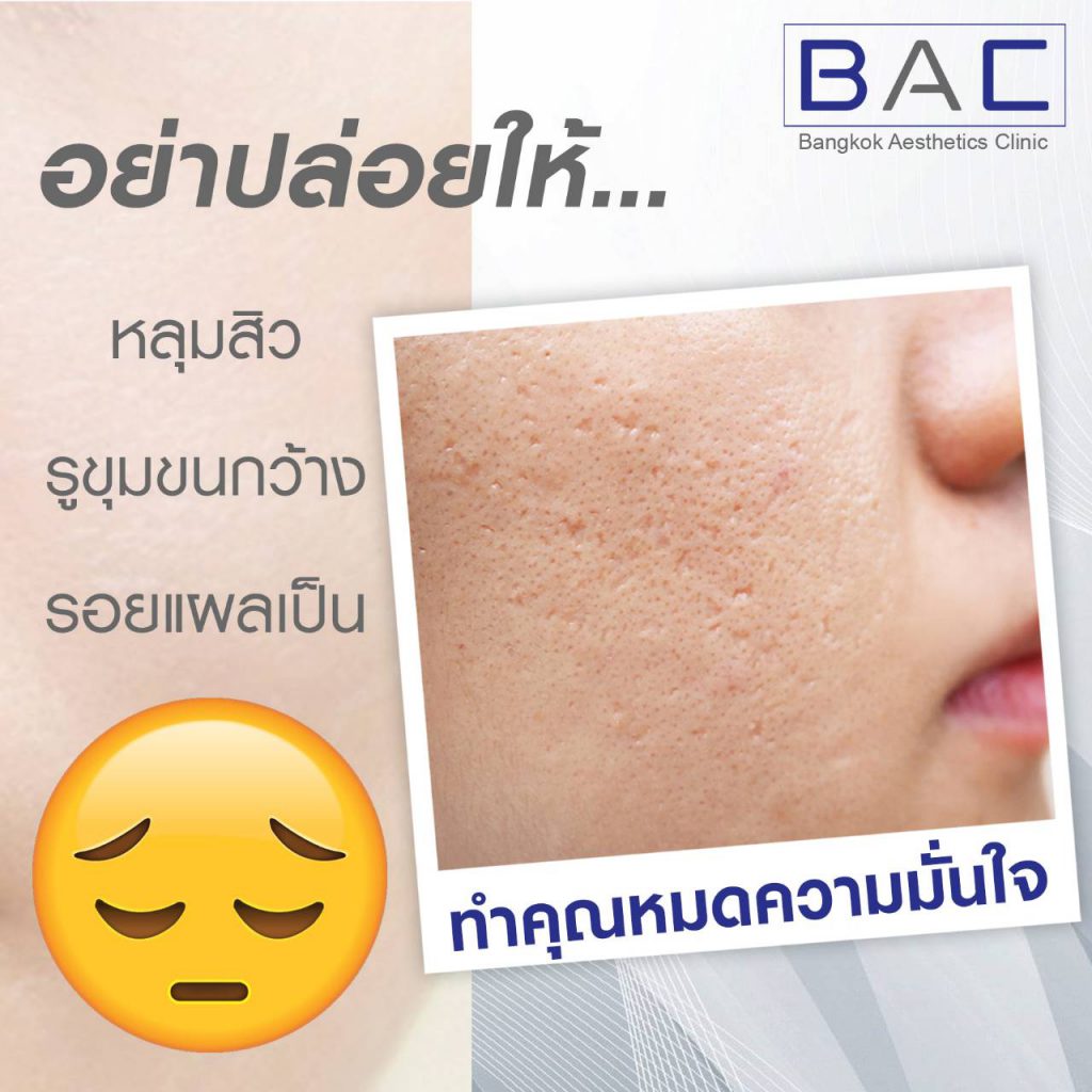 BAC Clinic คลินิกทำ eMatrix ปรับผิวหน้า ลดริ้วรอยผิว ที่เด่นชัดให้ดูจางลง - 2