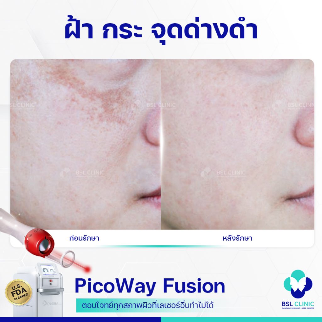 BSL Clinic เลเซอร์ผิวขาว กรุงเทพ เสริมจุดเด่นของผิว นวัตกรรมทันสมัยทุกขั้นตอนทำ - 2