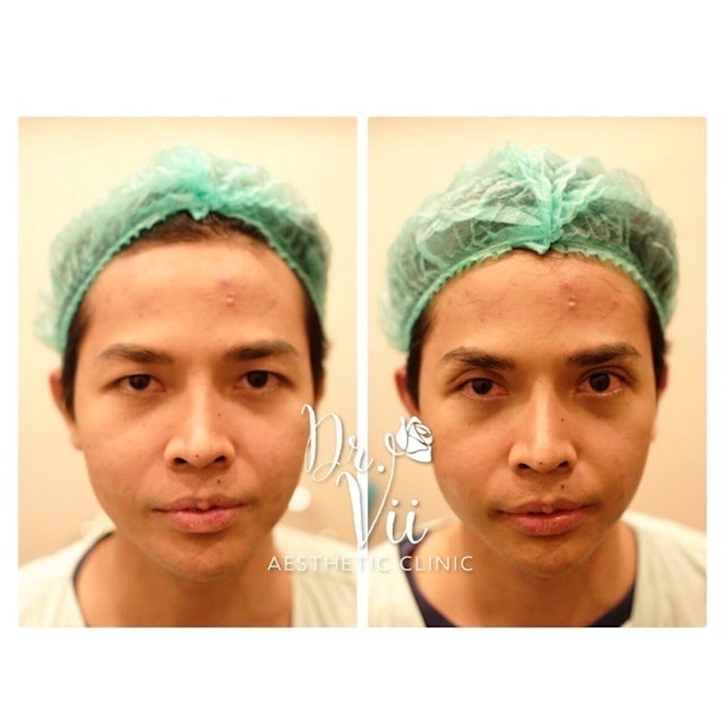 DR.Vii Clinic คลินิกทำตาสองชั้นผู้ชาย แก้หนังตาตก ตาตก เสริมหล่อด้วยตาให้ผู้ชายดูมั่นใจ - 2