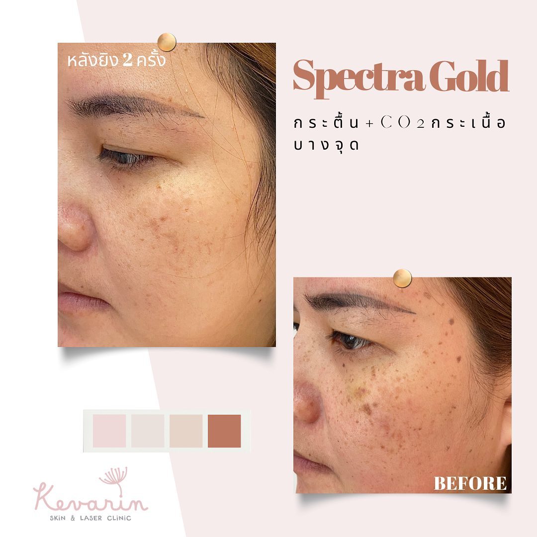 Kevarin Clinic คลินิกเลเซอร์ผิวขาว ขอนแก่น สร้างสัมผัสผิวที่โดดเด่น ผิวขาวเนียนนุ่มทำได้ง่าย - 2