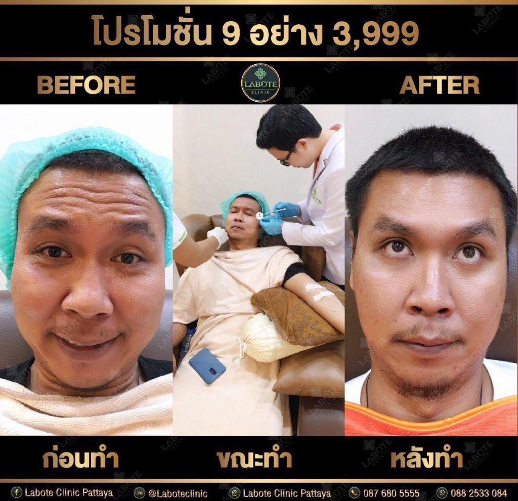 Labote Clinic บริการโบท็อก ชลบุรี ปรับรูปหน้า กระชับผิวพรรณ บำรุงผิวเสียให้กลับมาดีขึ้น - 2