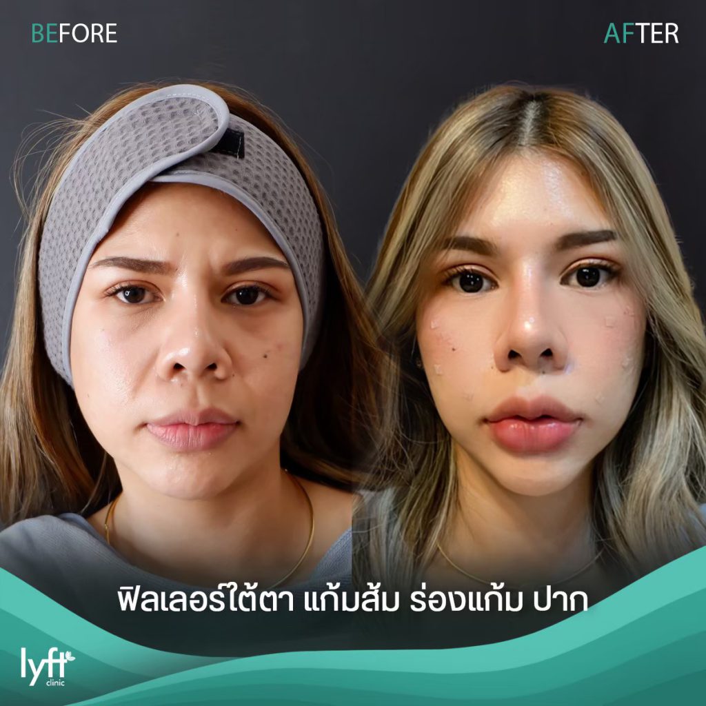 Lyft Clinic คลินิกฉีดฟิลเลอร์ ชลบุรี โปรแกรม Under Eye Fillers ลบริ้วรอยผิวใต้ตาที่เด่นชัด - 2