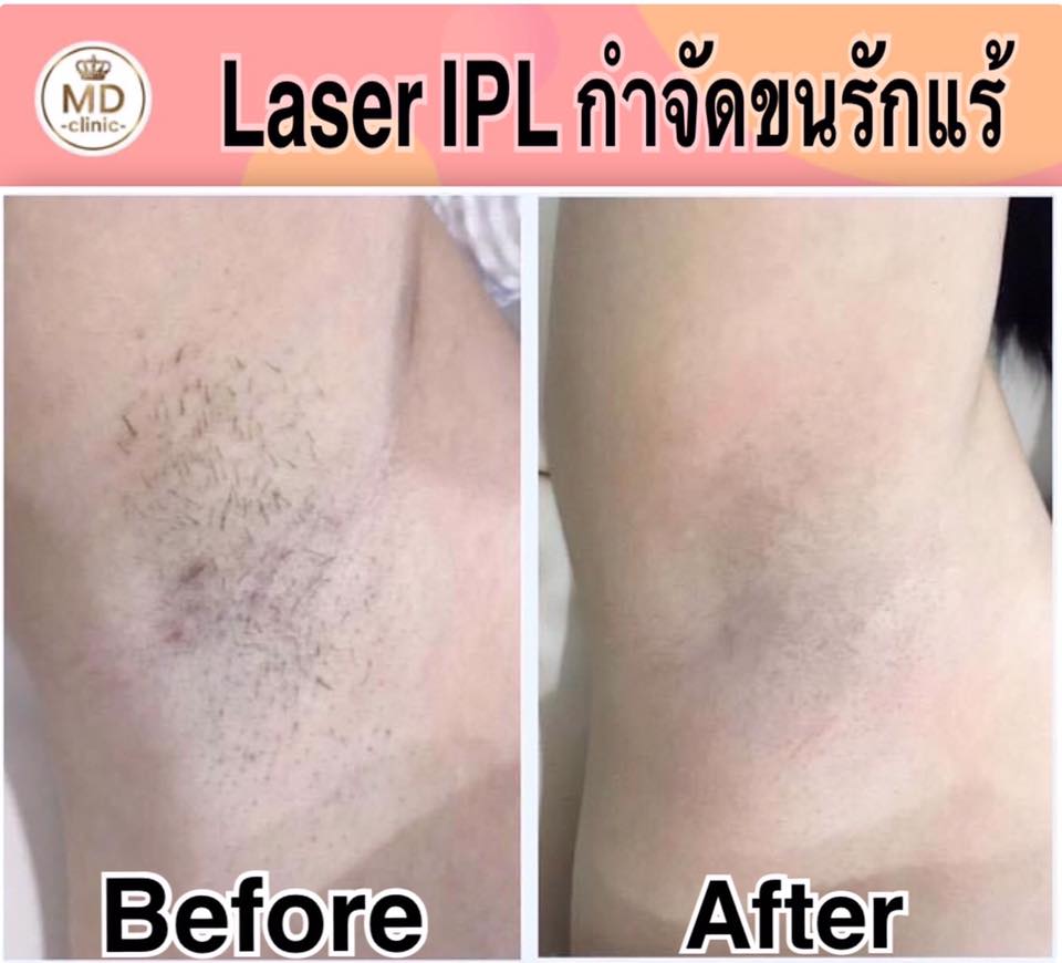 MD Clinic บริการเลเซอร์ผิวขาว ขอนแก่น การมีผิวแข็งแรง ขาวใส เริ่มต้นได้ที่คลินิกนี้ - 2