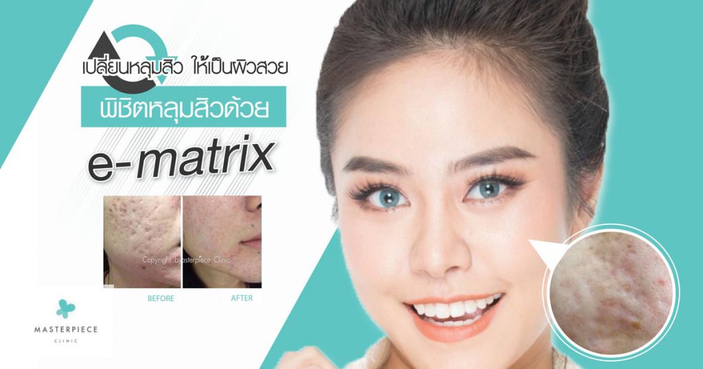 Masterpiece Hospital คลินิกทำ eMatrix นวัตกรรมการทำเลเซอร์ผิวหน้ารุ่นล่าสุด - 1