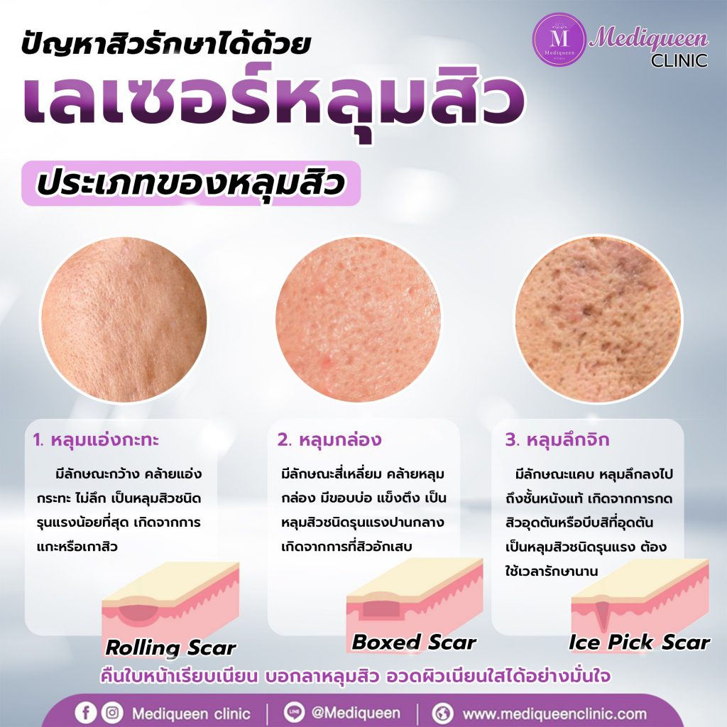 Mediqueen Clinic คลินิกเลเซอร์ผิวขาว พัทยา ปรับสีผิว ลงลึกถึงชั้นผิวได้อย่างปลอดภัย - 2