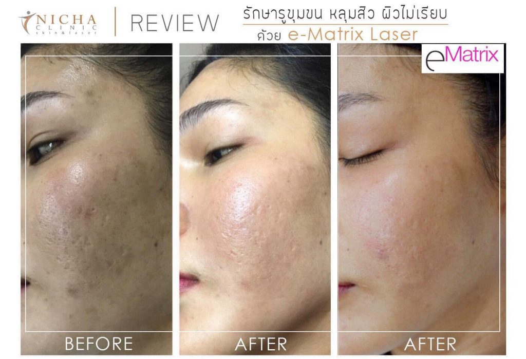 Nicha Clinic คลินิกรับทำ eMatrix ลดการเกิดริ้วรอยผิวหน้า ปรับสมดุลผิวให้ดีกว่าเดิม - 2