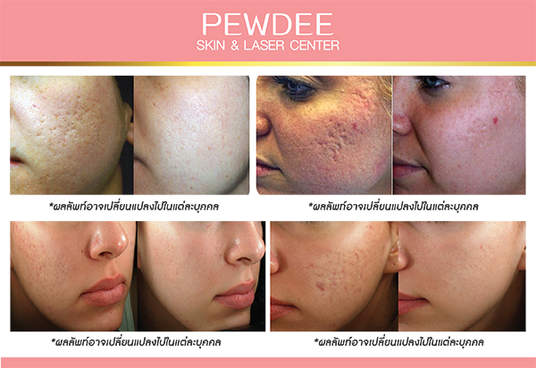 Pewdee Clinic รับทำ eMatrix เริ่มต้นความมั่นใจของผิวที่กลับมาดูเด็กลงได้อย่างที่ฝันไว้ - 2