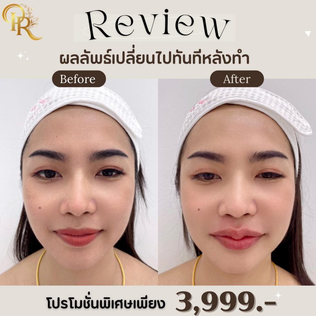 Purra Clinic ฉีดฟิลเลอร์ ชลบุรี หมดปัญหาของริ้วรอยผิวที่กวนใจ ให้ผิวหน้าดูอ่อนวัยลง - 2