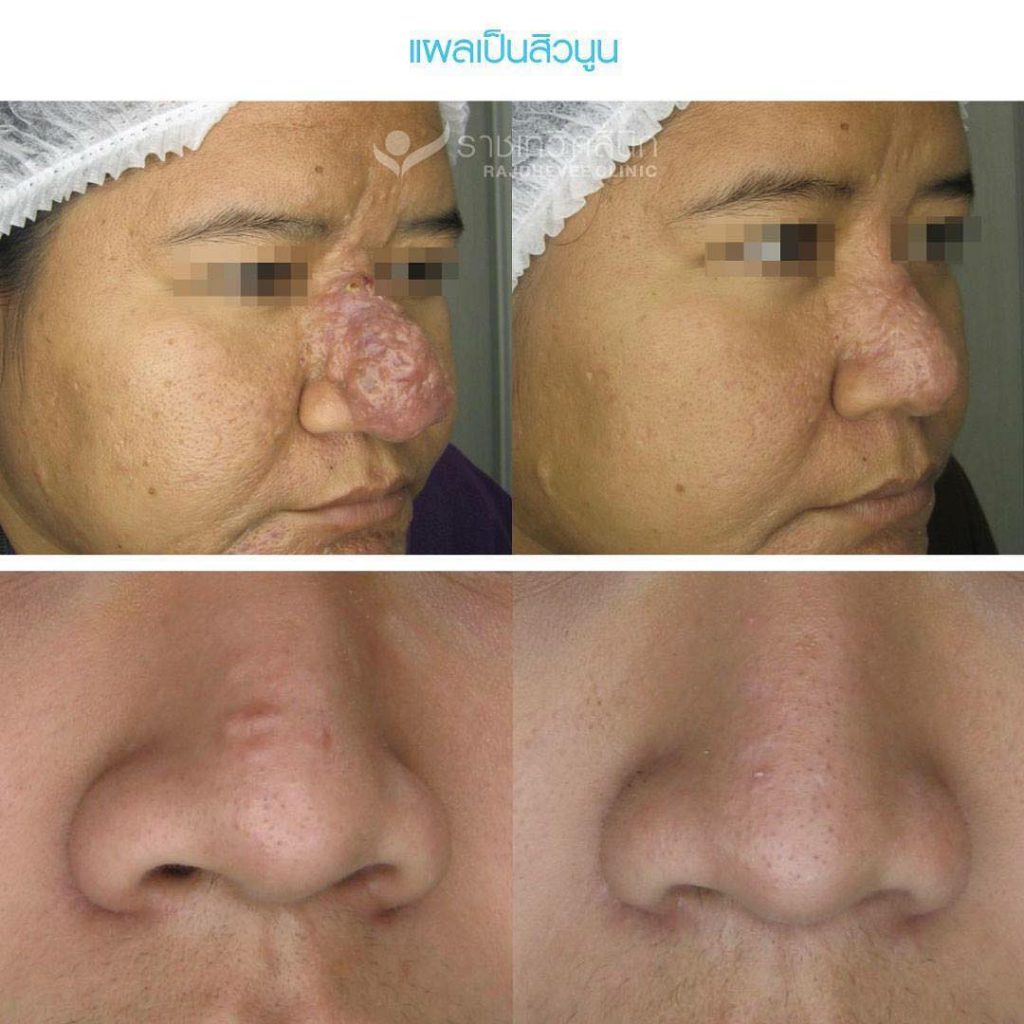 Rajdhevee Clinic บริการรักษาสิว ฝ้า กระ ชลบุรี แก้ปัญหาผิวด้วยวิธีการทันสมัย - 2