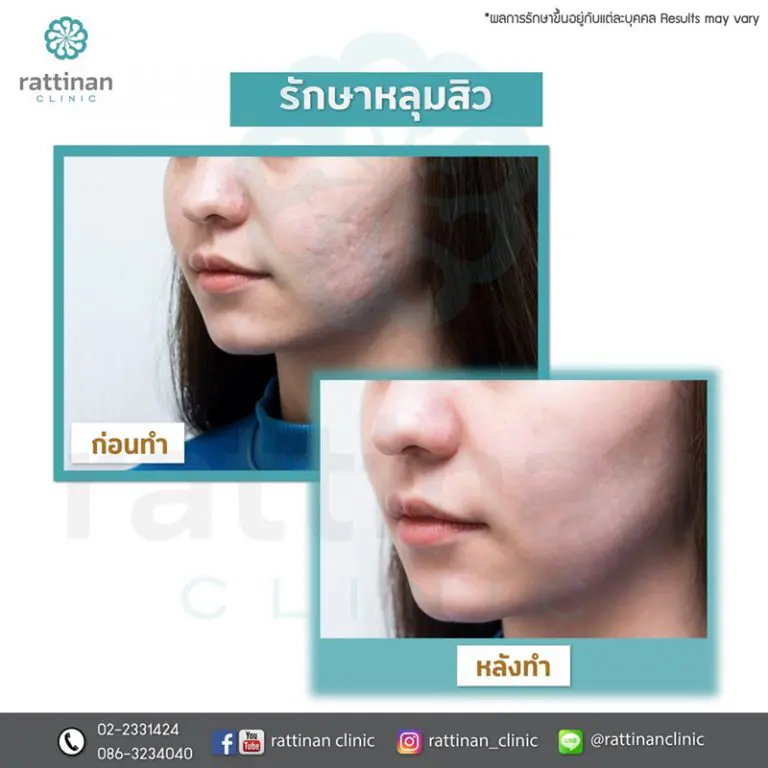 Rattinan Clinic รับทำ eMatrix กระตุ้นการทำงานของเซลล์ผิวชั้นใน ลบริ้วรอยที่เด่นชัด - 2