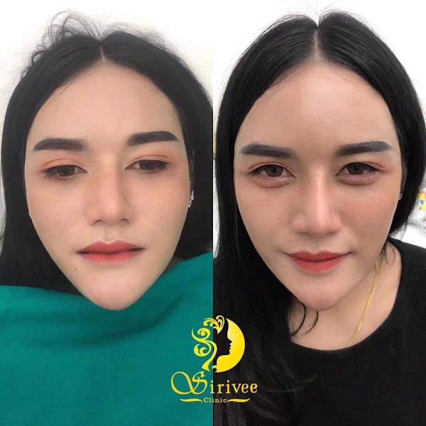 Sirivee Clinic ฉีดโบท็อก ชลบุรี เสริมความงามให้ผิว เสริมจุดเด่นให้ใบหน้าได้อย่างมั่นใจ - 2