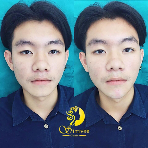 Sirivee Clinic บริการร้อยไหม ชลบุรี ทุกปัญหารูปหน้าที่น่ากังวล ปรับหน้าเรียวสวย เลือกคลินิกนี้ - 2