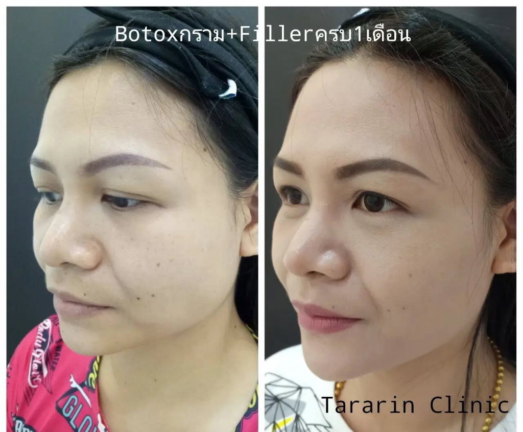 Tararin Clinic บริการโบท็อก ขอนแก่น ฉีดโบลดกราม ปรับหน้าเรียวสวย - 2