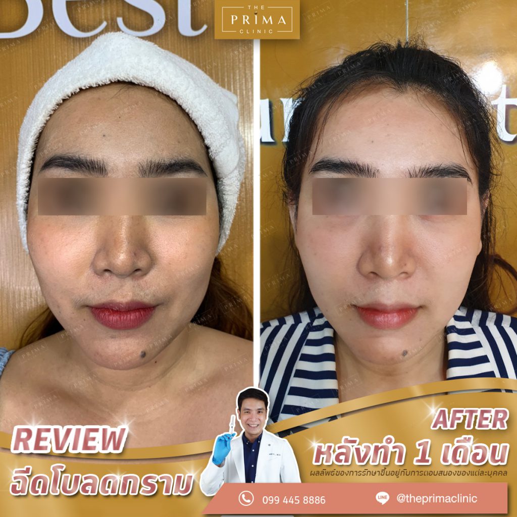 The Prima Clinic คลินิกโบท็อก ชลบุรี เคลียร์ริ้วรอยผิว รักษา บำรุงผิวกระจ่างใสมากขึ้น - 2