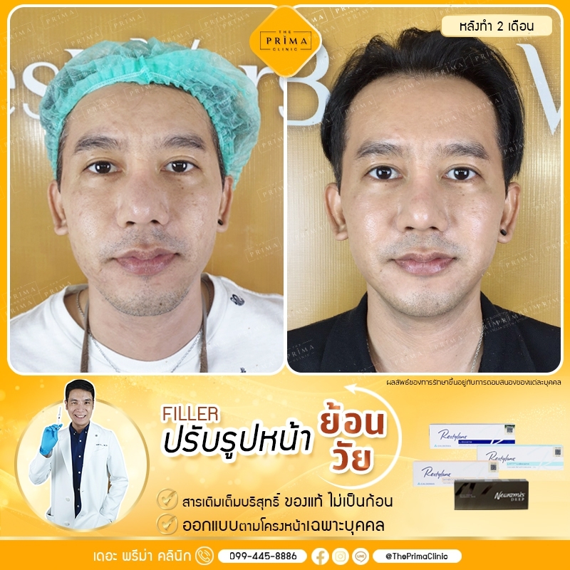 The Prima Clinic ฉีดฟิลเลอร์ ชลบุรี มั่นใจได้ทุกขั้นตอนการฉีด หมอผู้เชี่ยวชาญเฉพาะทาง - 2