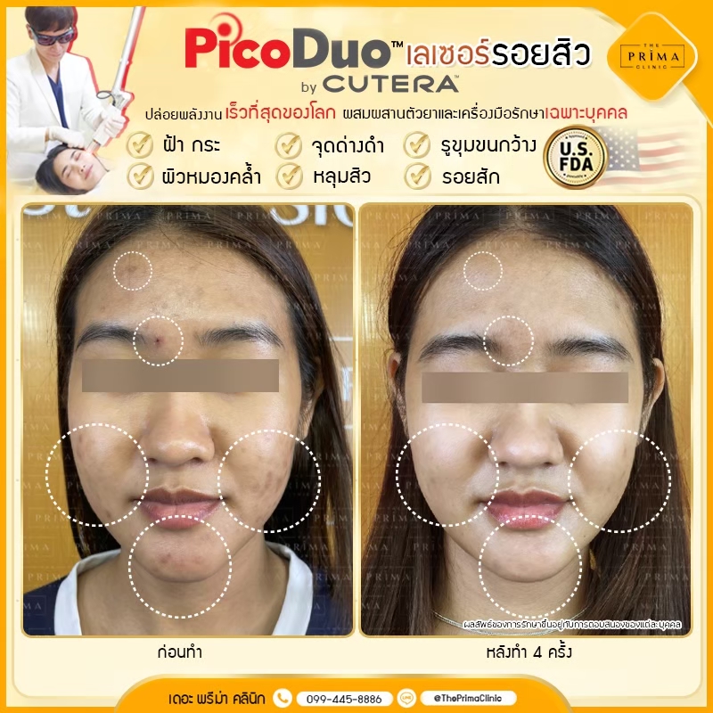 The Prima Clinic รักษาสิว ฝ้า กระ ชลบุรี ปรับผิวขาว ฟื้นฟูทุกเซลล์ผิวจากปัญหาสิวฝังลึก - 2