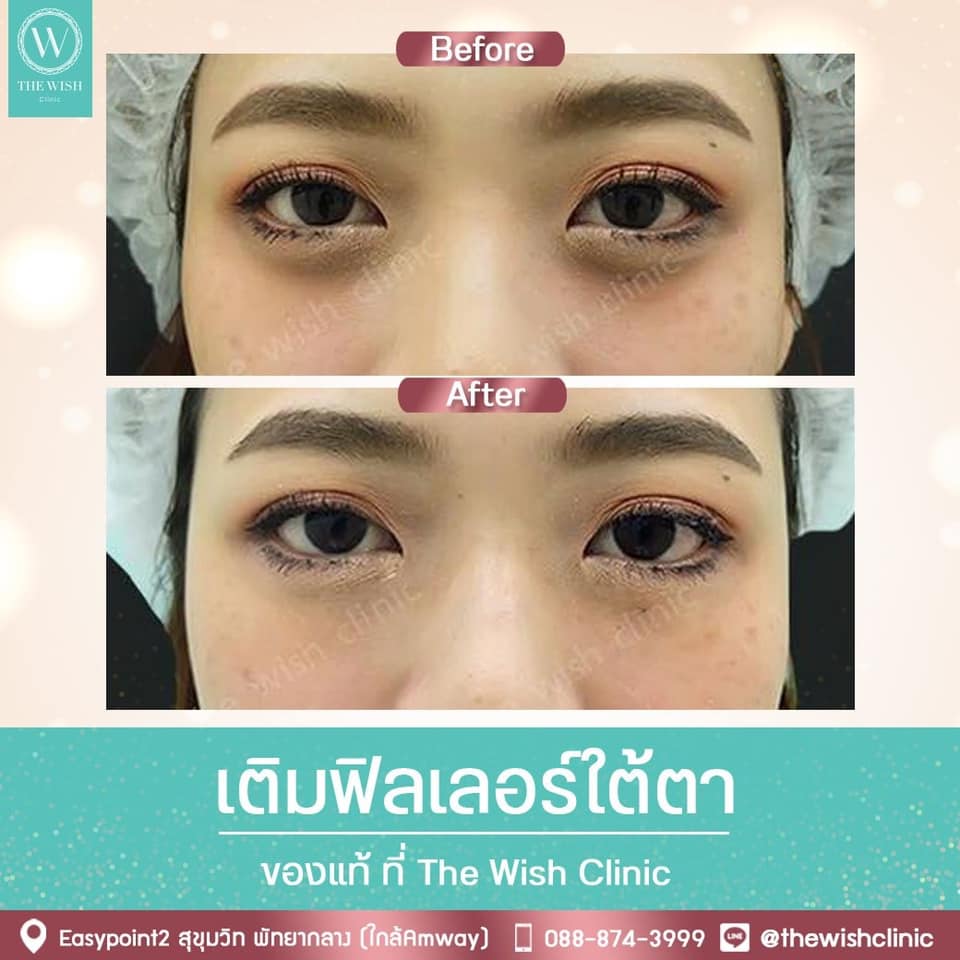 The Wish Clinic บริการฉีดฟิลเลอร์ ชลบุรี ปรับหน้าเรียว เติมเต็มร่องแก้ม ลดริ้วรอยของใบหน้า - 2