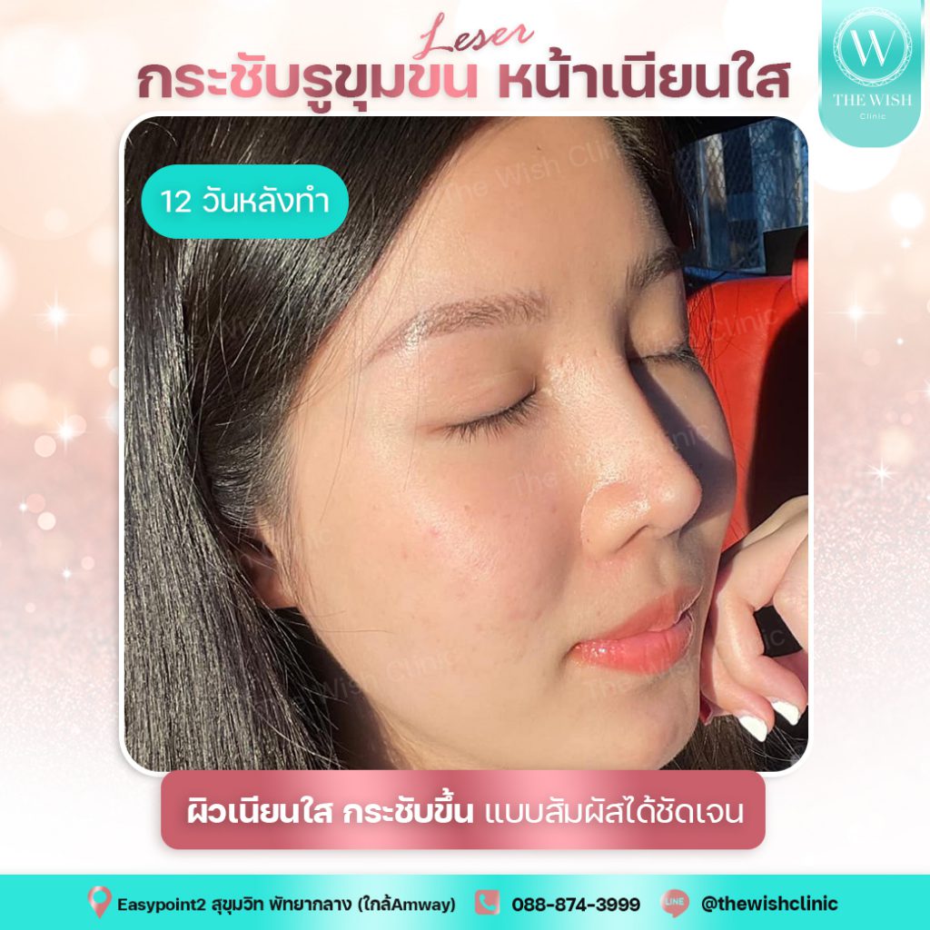 The Wish Clinic เลเซอร์ผิวขาว พัทยา เสริมความขาวใสของผิวได้อย่างมีคุณภาพ - 2The Wish Clinic เลเซอร์ผิวขาว พัทยา เสริมความขาวใสของผิวได้อย่างมีคุณภาพ - 2