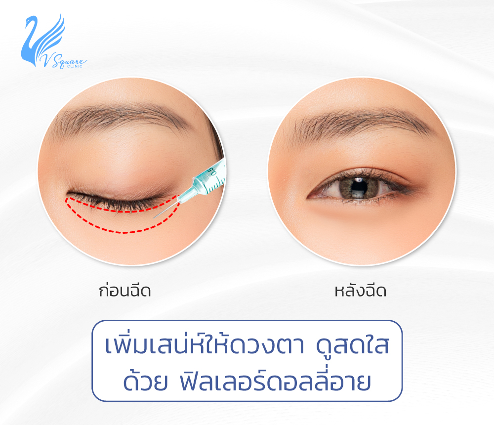 V square Clinic บริการฉีดดอลลี่อาย ฉีดฟิลเลอร์ ไขมันตัวเอง ทำได้อย่างมีคุณภาพ - 2