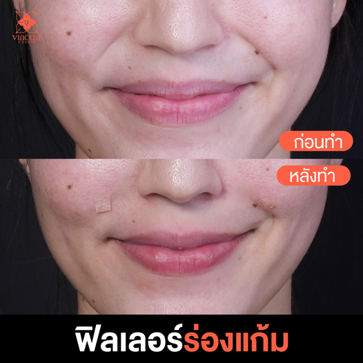 Vincent Clinic คลินิกฉีดฟิลเลอร์ ชลบุรี โปรแกรมฉีด Filler มาตรฐาน คุณภาพดี - 2