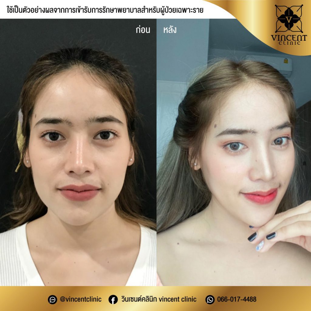 Vincent Clinic บริการฉีดโบท็อก ชลบุรี โบลดกราม สร้างเรียวหน้าสวยเป็นที่น่าจดจำ - 2