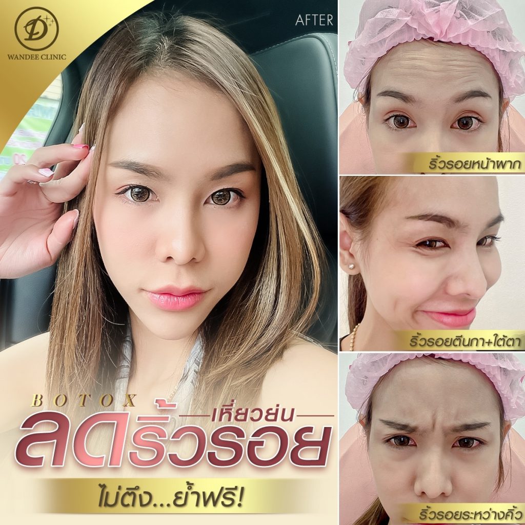 Wandee Clinic คลินิกโบท็อก ขอนแก่น ให้ความมั่นใจฉีดโบท็อกปรับรูปหน้าที่ได้มาตรฐาน - 2