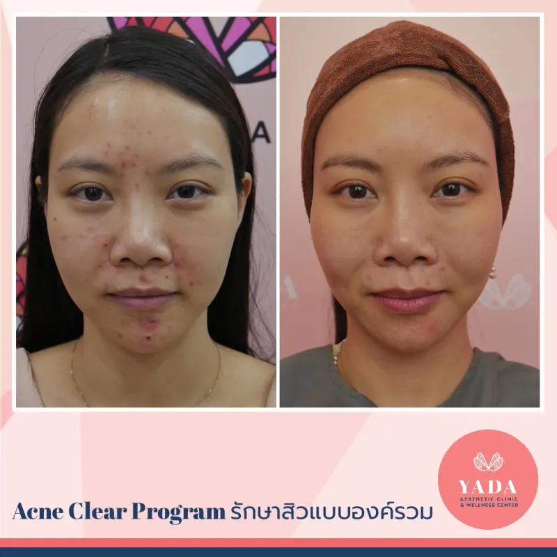 YADA Clinic รักษาสิว ฝ้า กระ ชลบุรี แพทย์ผู้เชี่ยวชาญทางด้านผิวพรรณและความงาม - 2