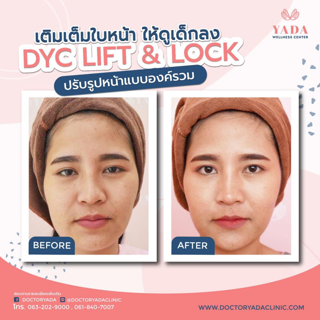 YADA Clinic โบท็อก ชลบุรี เทคนิคปรับรูปหน้า ยกกระชับผิวจากแพทย์ผู้เชี่ยวชาญ - 2