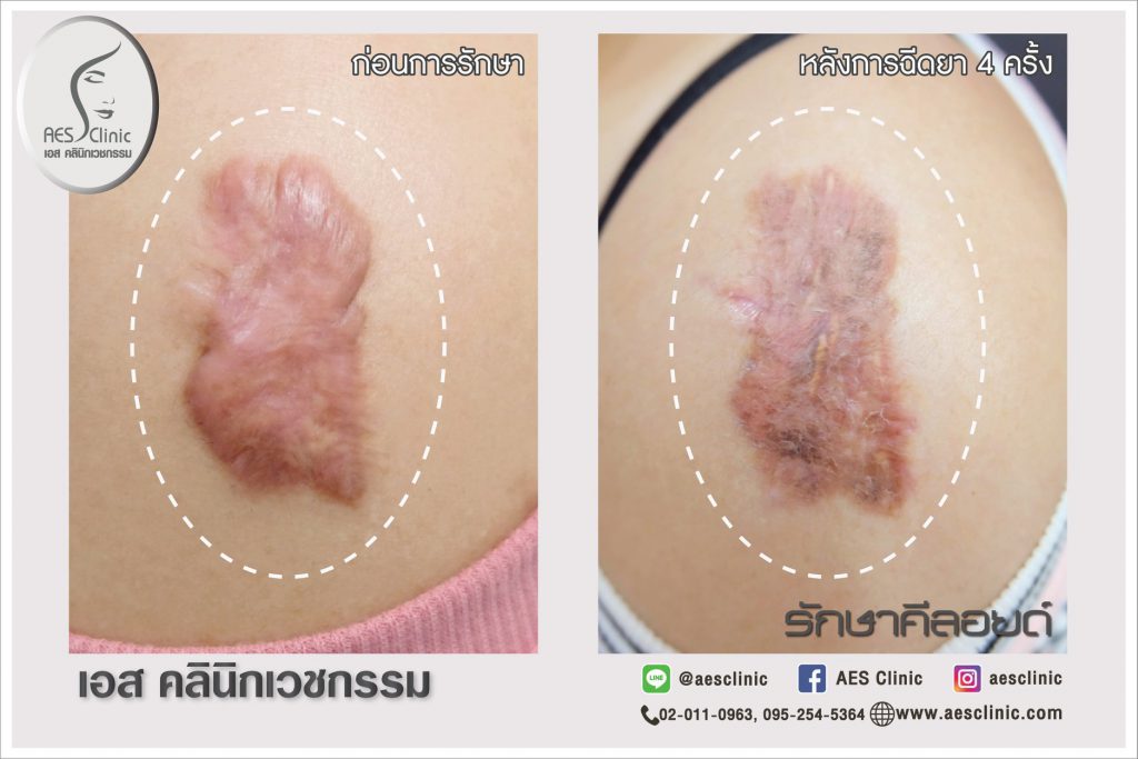 AES Clinic ศูนย์รักษาแผลเป็นนูน ปรึกษา วินิจฉัย ดำเนินการโดยแพทยผู้เชี่ยวชาญเฉพาะทาง - 2