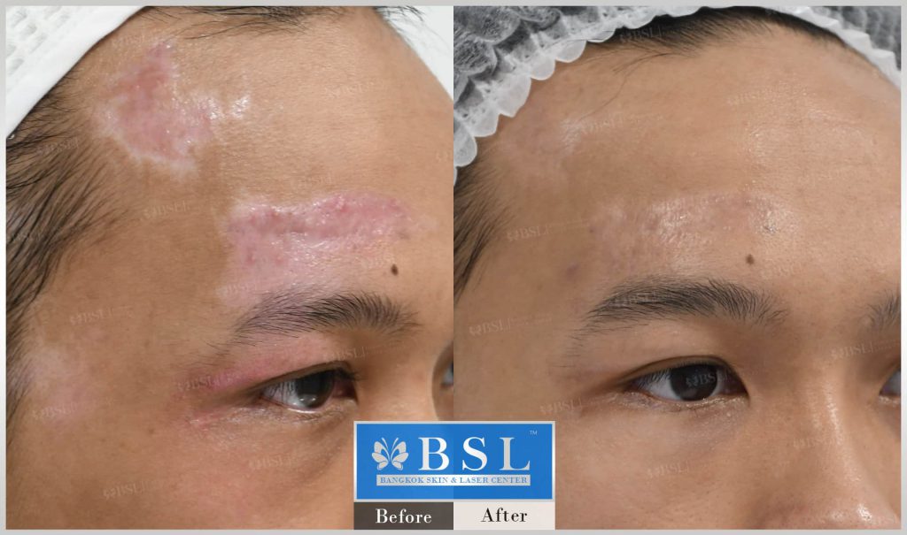 BSL Clinic รักษาแผลเป็นนูน แผลคีลอยด์ ปัญหาของผิวรักษาหายได้ไม่ต้องกังวล - 2