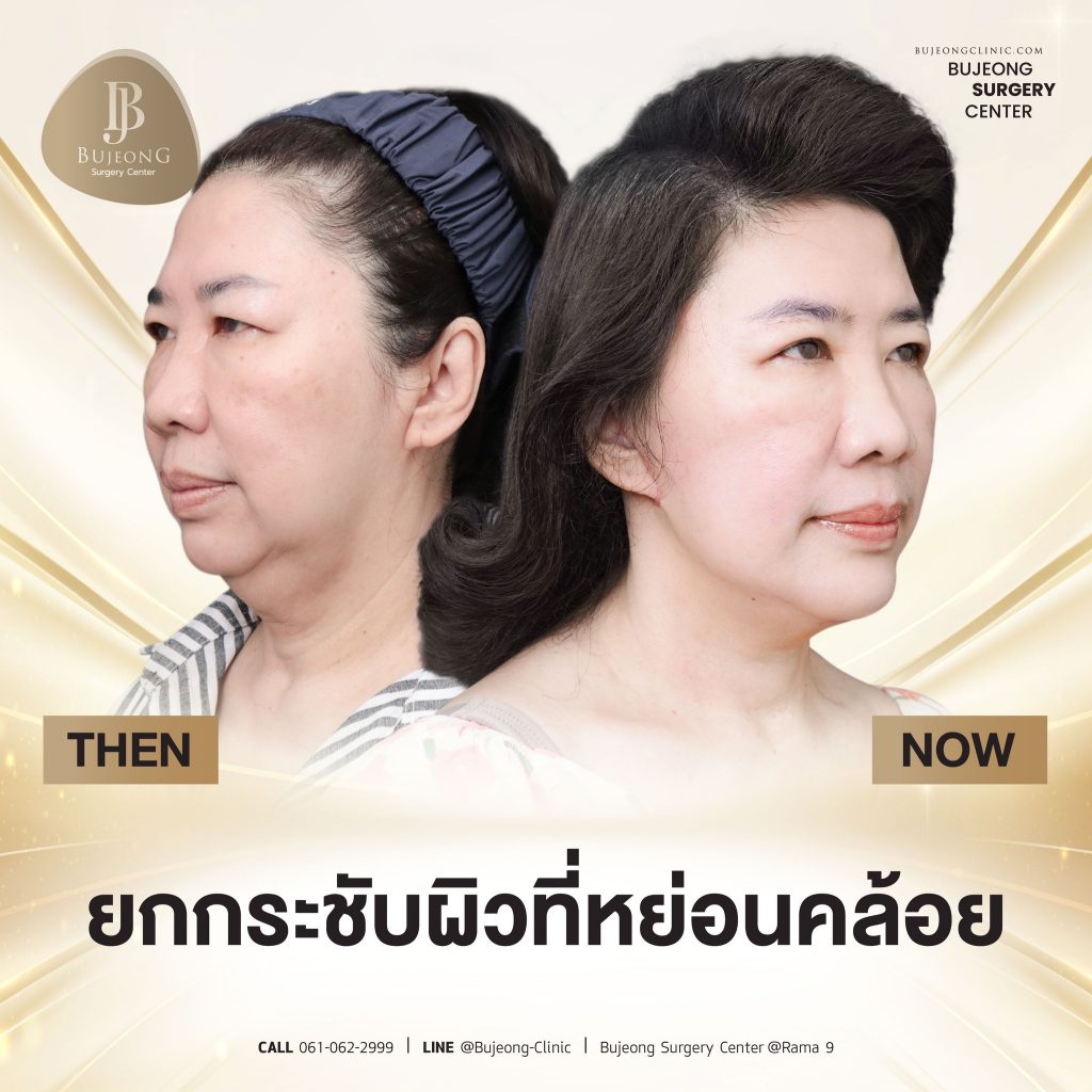 Bujeong Clinic บริการผ่าตัดยกหน้า ปรับหน้าสวย ปรับหน้าเรียว ลดริ้วรอยผิวดูจางลง - 2