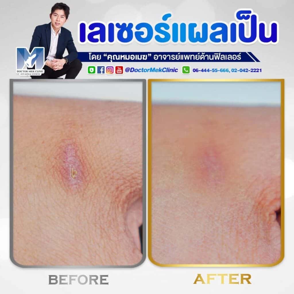 DoctorMek Clinic เลเซอร์รักษาแผลเป็นนูน เสริมความงามให้ผิวที่พังกลับมาปังอีกครั้ง - 2