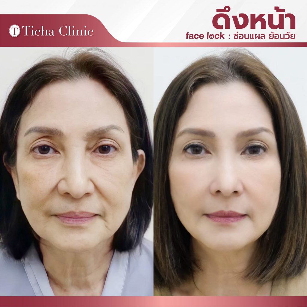 Ticha Clinic คลินิกผ่าตัดยกหน้า กระตุ้นใบหน้า ปรับลดริ้วรอยของผิวที่เห็นเด่นชัดให้ดูลดลง - 2