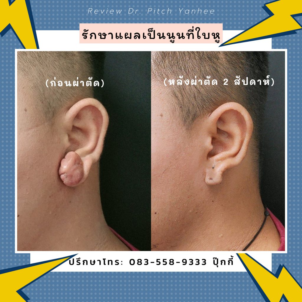 Yanhee Hospital ศูนย์รักษาแผลเป็นนูน รวมเทคนิคการรักษาที่ได้มาตรฐานปลอดภัย ไร้กังวล - 2