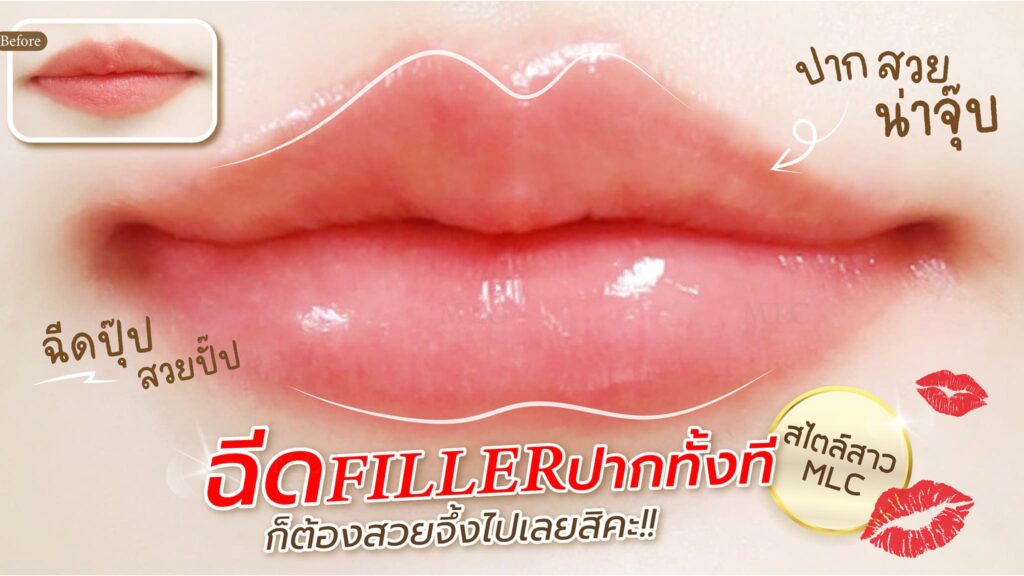 MLC Skin & Laser Clinic ฉีด Soft Filler เพิ่มความฉ่ำวาวให้ผิวหน้าดูเรียบเนียนเป็นธรรมชาติ