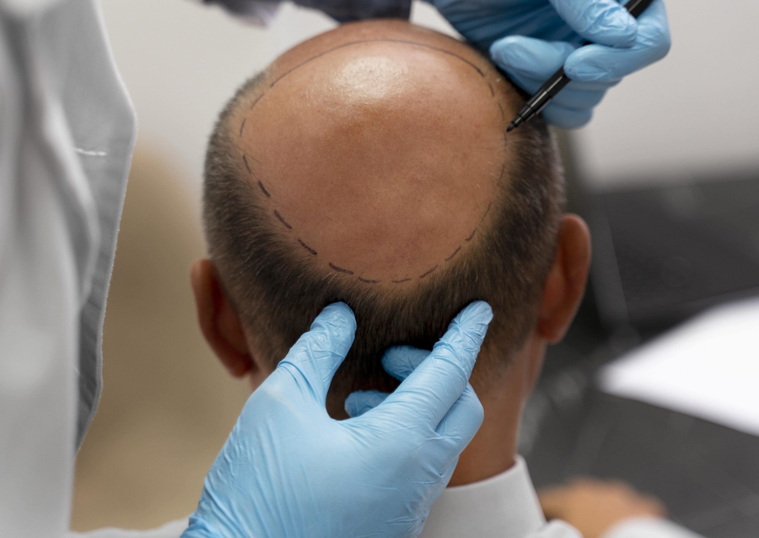 Where is a good hair transplant clinic in Rayong