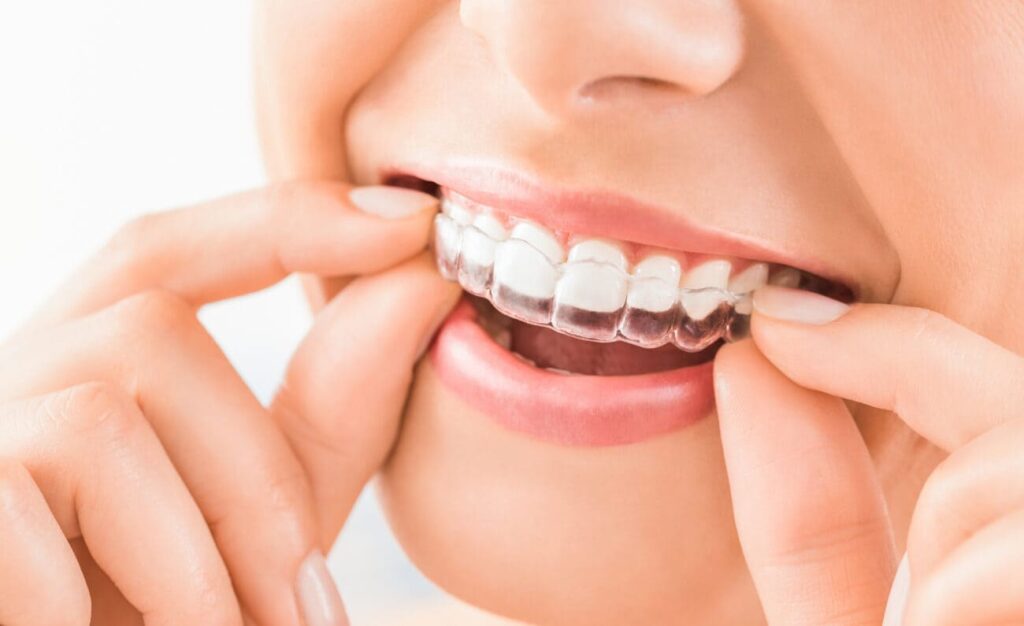 Where is a good place to get Invisalign clear braces