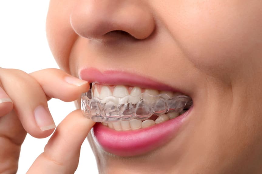 จัดฟันใส Invisalign ที่ไหนดี - 1